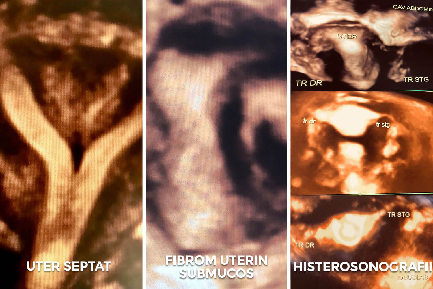 Ecografia de reconstrucție 3D a cavității uterine